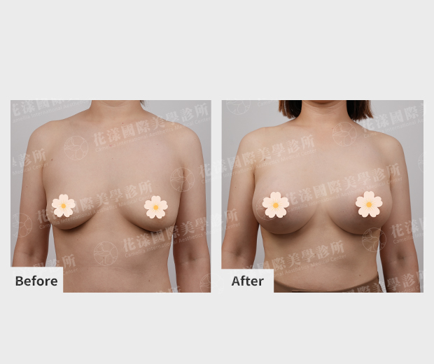 珍珠波隆乳案例1