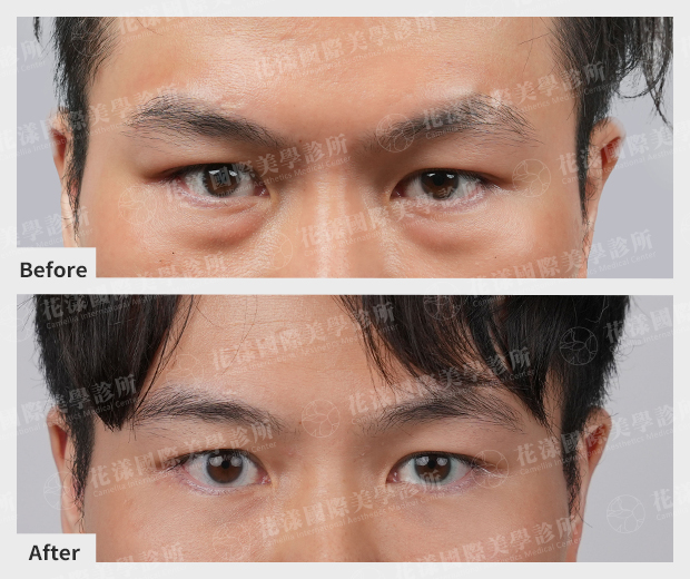 花漾國際美學診所【眼袋手術】案例圖 1