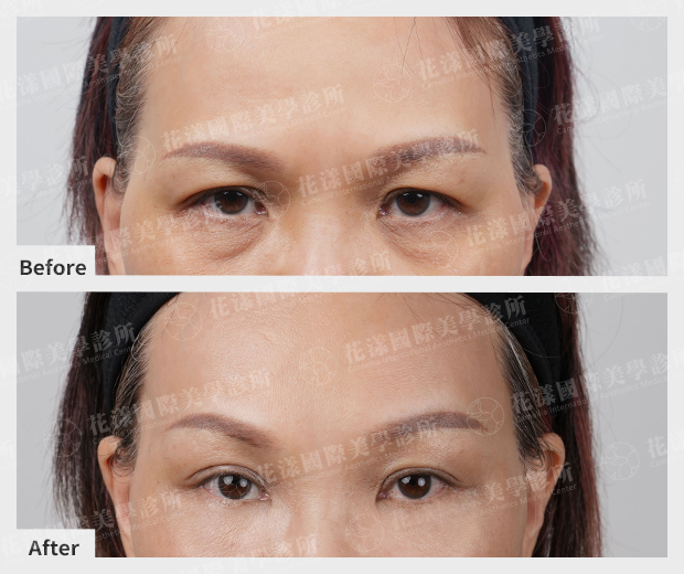 花漾國際美學診所【眼袋手術】案例圖 2