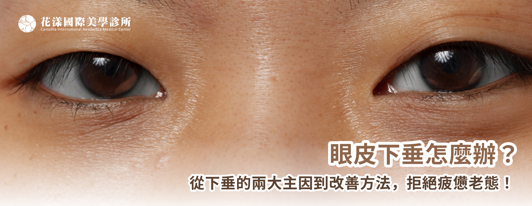 眼皮下垂怎麼辦？從下垂的兩大主因到改善方法，拒絕疲憊老態！