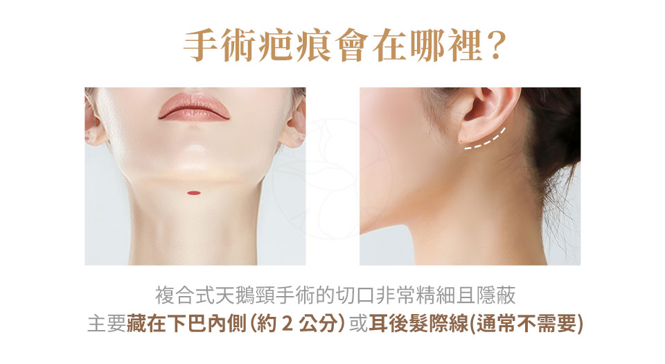 手術疤痕會在哪裡?會很明顯嗎? 複合式天鵝頸手術的切口非常精細且隱蔽,主要藏在下巴內側(約 2 公分)。 疤痕會隨著時間淡化成一條淺淺的細線,難以被察覺。