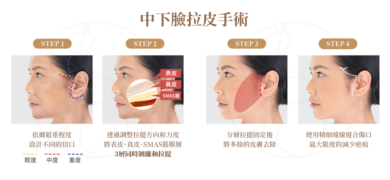 改善嘴邊肉下垂、木偶紋和法令紋最直接有效的方式，能一次性將鬆弛的組織復位，重塑清晰的下顎線。