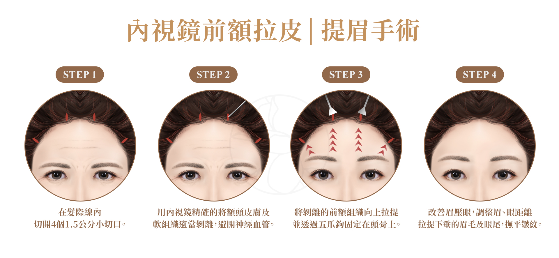 針對上臉部老化，能有效改善額頭鬆弛、拉高下垂的眉毛，並消除大部分抬頭紋。