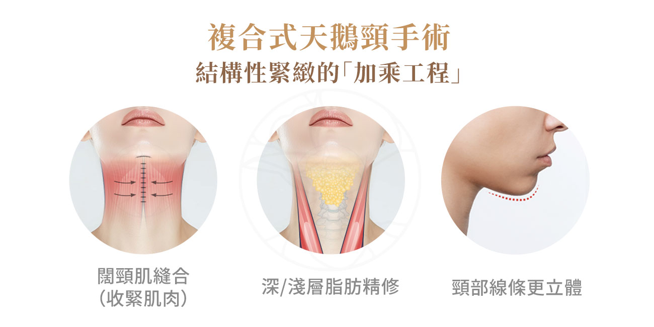 1. 頸闊肌縫合（收緊肌肉）2. 深／淺層脂肪精修 3..皮膚筋膜拉提：