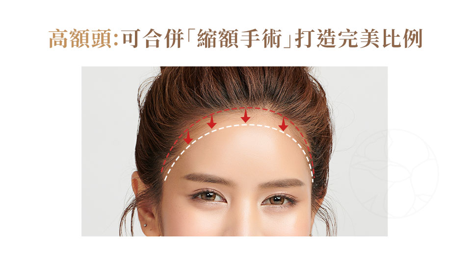 縮額手術 在髮際線邊緣精準切除一小塊額頭皮膚,然後將頭皮向前拉提,與額頭皮膚進行縫合。