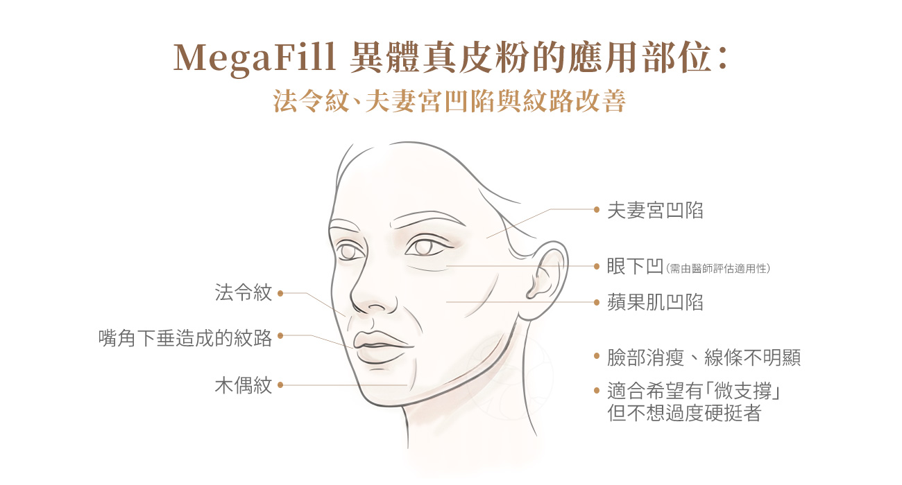 MegaFill 異體真皮粉的應用部位：法令紋、夫妻宮凹陷與紋路改善