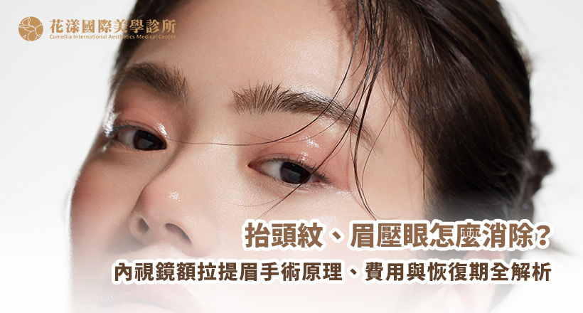抬頭紋、眉壓眼根本改善指南 抬頭紋、眉壓眼根本改善指南:內視鏡額拉提眉手術(前額拉提)原理與最佳適用對象