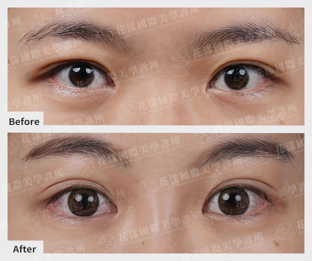 雙眼皮手術成果 雙眼皮手術成果|摺線均勻、眼神更有精神