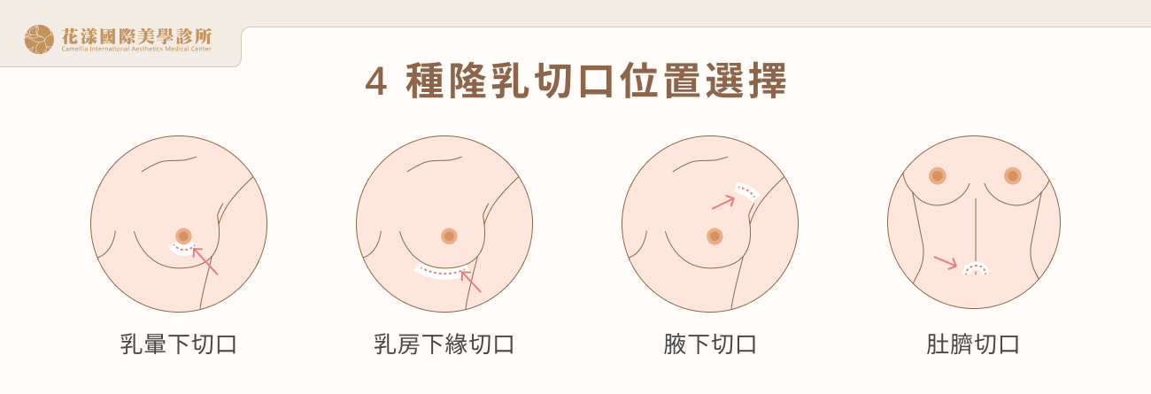 4 種隆乳切口位置選擇
