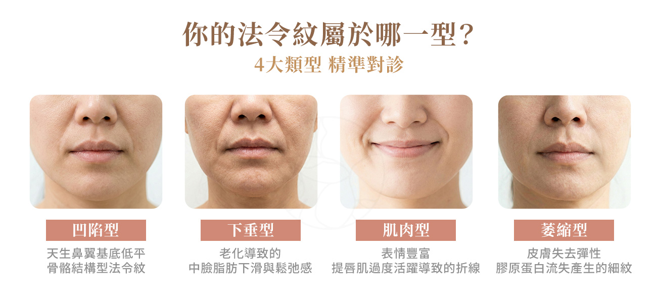 法令紋的4個類型1. 凹陷型2. 下垂型3. 肌肉型4. 萎縮型