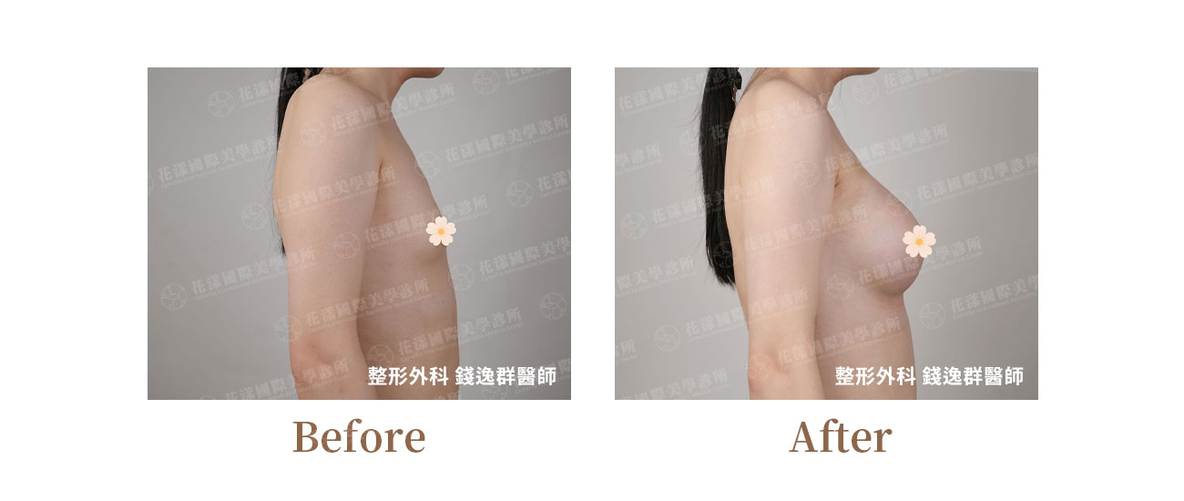 跨性別隆乳、男性隆乳 跨性別隆乳、男性隆乳