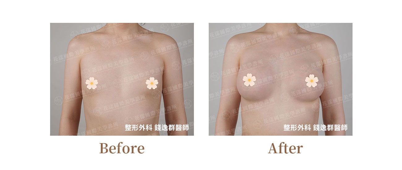 跨性別隆乳、男性隆乳 跨性別隆乳、男性隆乳