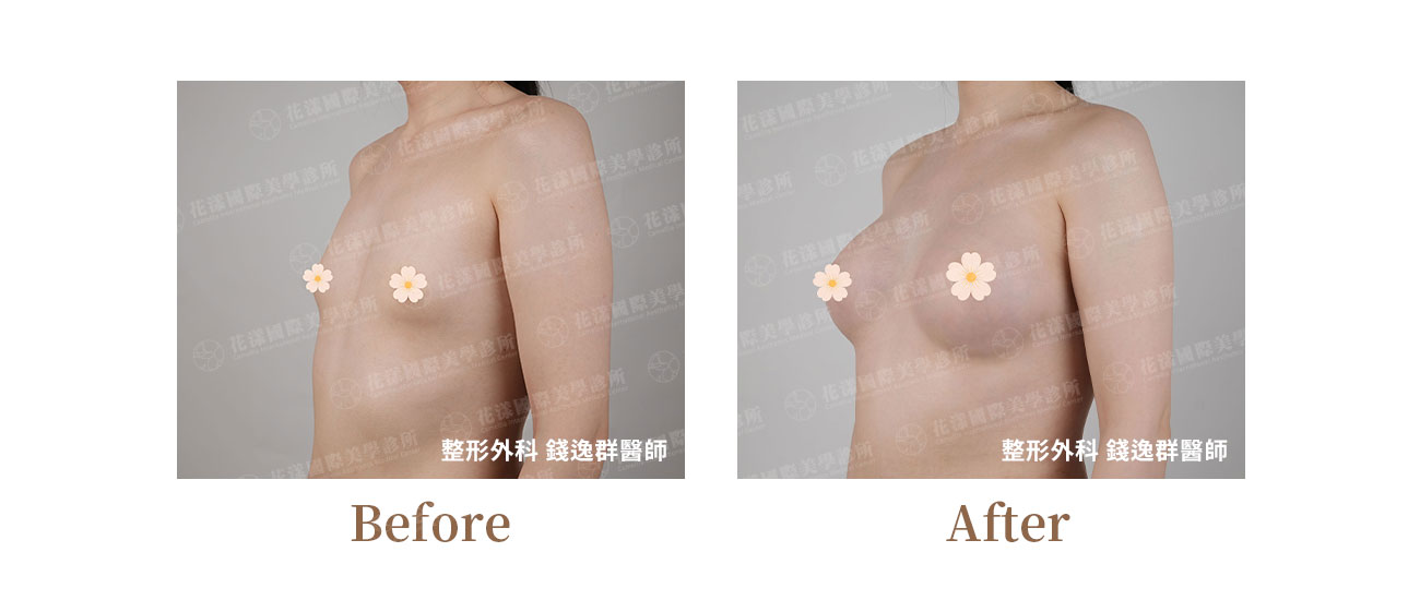 跨性別隆乳、男性隆乳 跨性別隆乳、男性隆乳