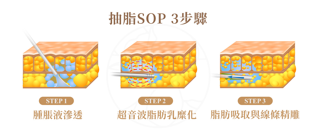 抽脂3步驟1.腫脹液滲透 2. 超音波脂肪乳化 3.脂肪吸取（Aspiration）與線條精雕