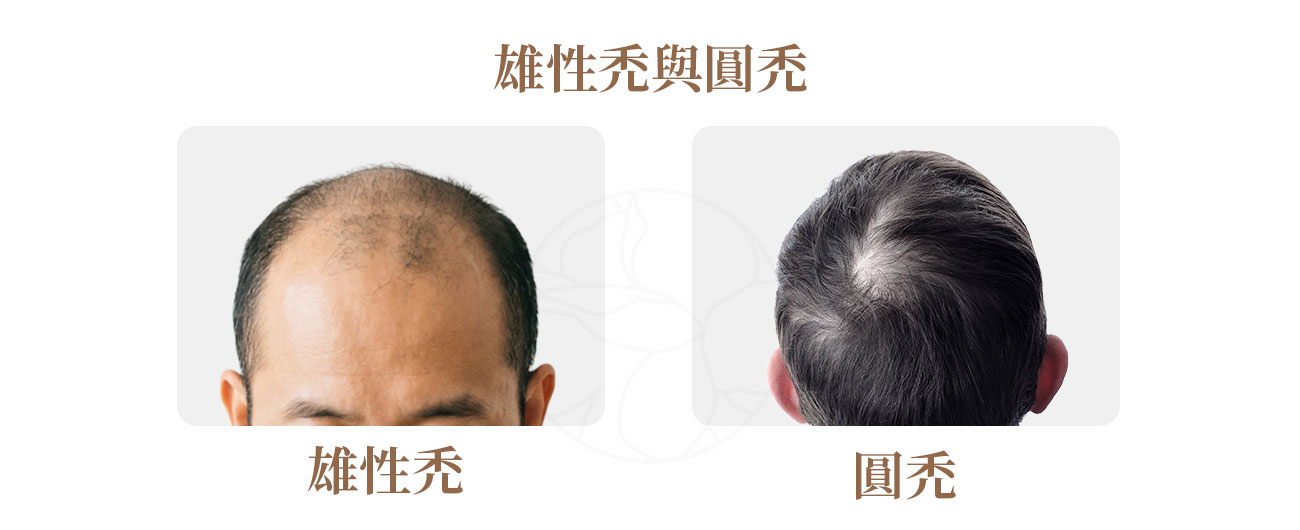 雄性禿(Androgenetic Alopecia, AGA)與圓禿(Alopecia Areata)圖示 雄性禿(Androgenetic Alopecia, AGA)與圓禿(Alopecia Areata)圖示