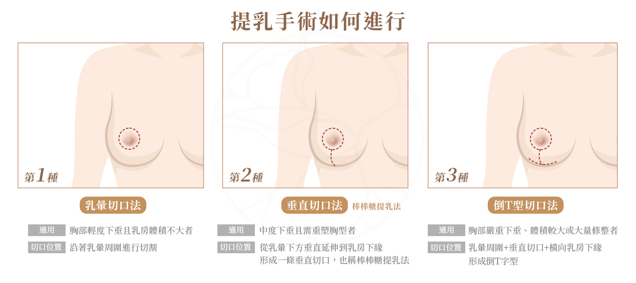 提乳手術切口可分3種，第1種乳暈切口，第2種垂直切口法，第3種倒T型切口法