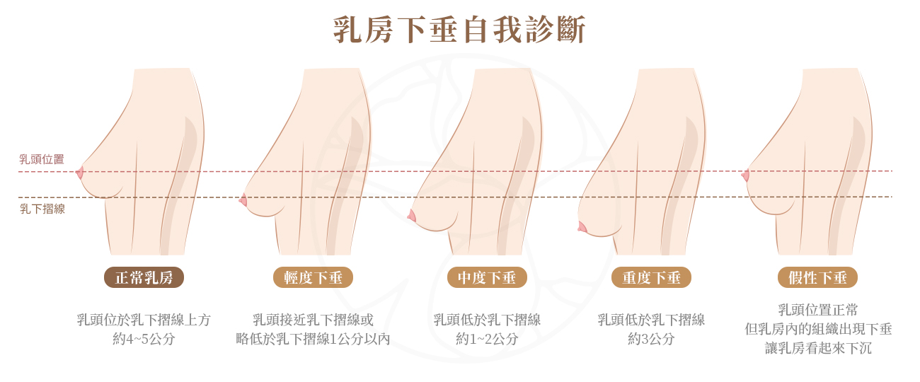 乳房下垂程度可分0-3級，0 級：正常乳房，1 級：輕到中度下垂、或嚴重肥大，2 級重度下垂、或中度容積流失、或乳房緊縮，3 級嚴重側胸贅肉、嚴重容積流失、皮膚鬆垮、乳房扁平