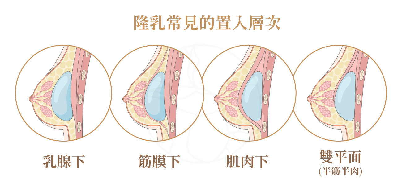 義乳放在哪一層?四種放置位置完整說明 義乳四種放置位置完整說明: 1:乳腺下(Subglandular),適合軟組織夠厚者 2 :筋膜下(Subfascial),乳腺下與肌肉下之間的選擇 3:胸大肌下(Submuscular/Subpectoral),多用於乳房重建4:雙平面(Dual Plane),俗稱「半筋半肉」,目前最受歡迎