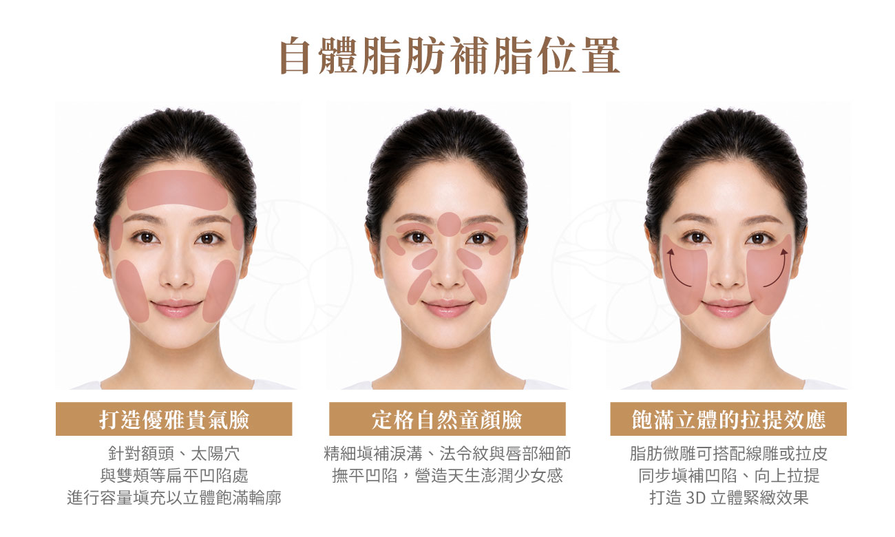 臉部各部位自體脂肪補脂指南 臉部各部位自體脂肪補脂指南:額頭、太陽穴、淚溝、蘋果肌、法令紋到下顎線