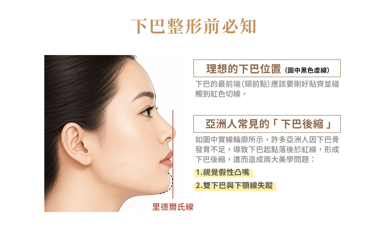 理想的下巴位置（圖中黑色虛線）：在最符合現代審美的側臉結構中，下巴的最前端（頦前點）應該要剛好貼齊、碰觸到這條紅色切線。  亞洲人常見的「下巴後縮」背叛： 如圖中原本的實線輪廓，許多東方人因為下巴骨發育不全，下巴起點遠遠落後於紅線之後（下巴後縮），致成２大美學問題(1) 視覺假性凸嘴(2)雙下巴與下顎線失蹤