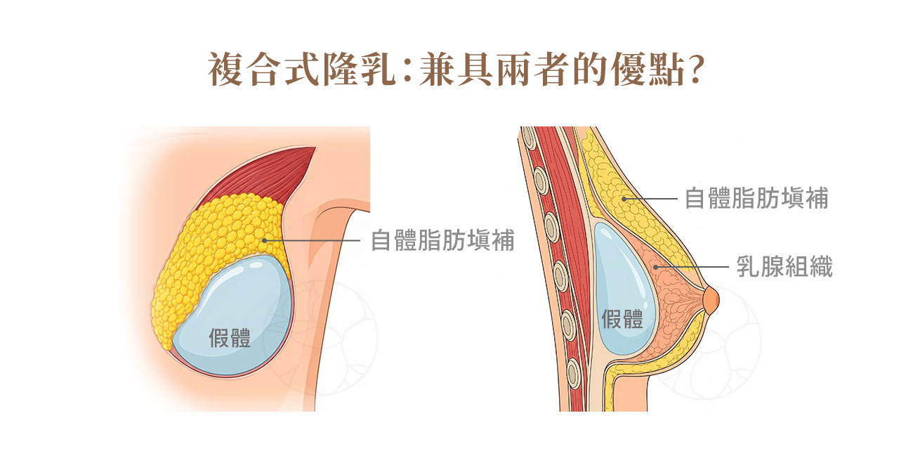 七、複合式隆乳(Hybrid Breast Augmentation)是什麼?義乳+自體脂肪 七、複合式隆乳(Hybrid Breast Augmentation)是什麼?義乳+自體脂肪