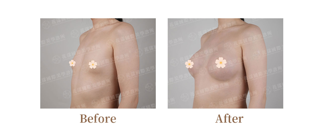 跨性別隆乳術前後對比照-45度｜20多歲顧客腋下切口、寬基底胸廓案例｜整形外科錢逸群醫師