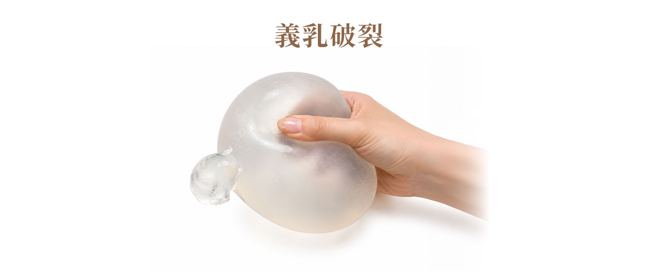 併發症 5:義乳破裂(Rupture) 併發症 5:義乳破裂(Rupture),矽膠義乳破裂可能無明顯症狀(需影像檢查發現),鹽水袋破裂則會明顯消氣。