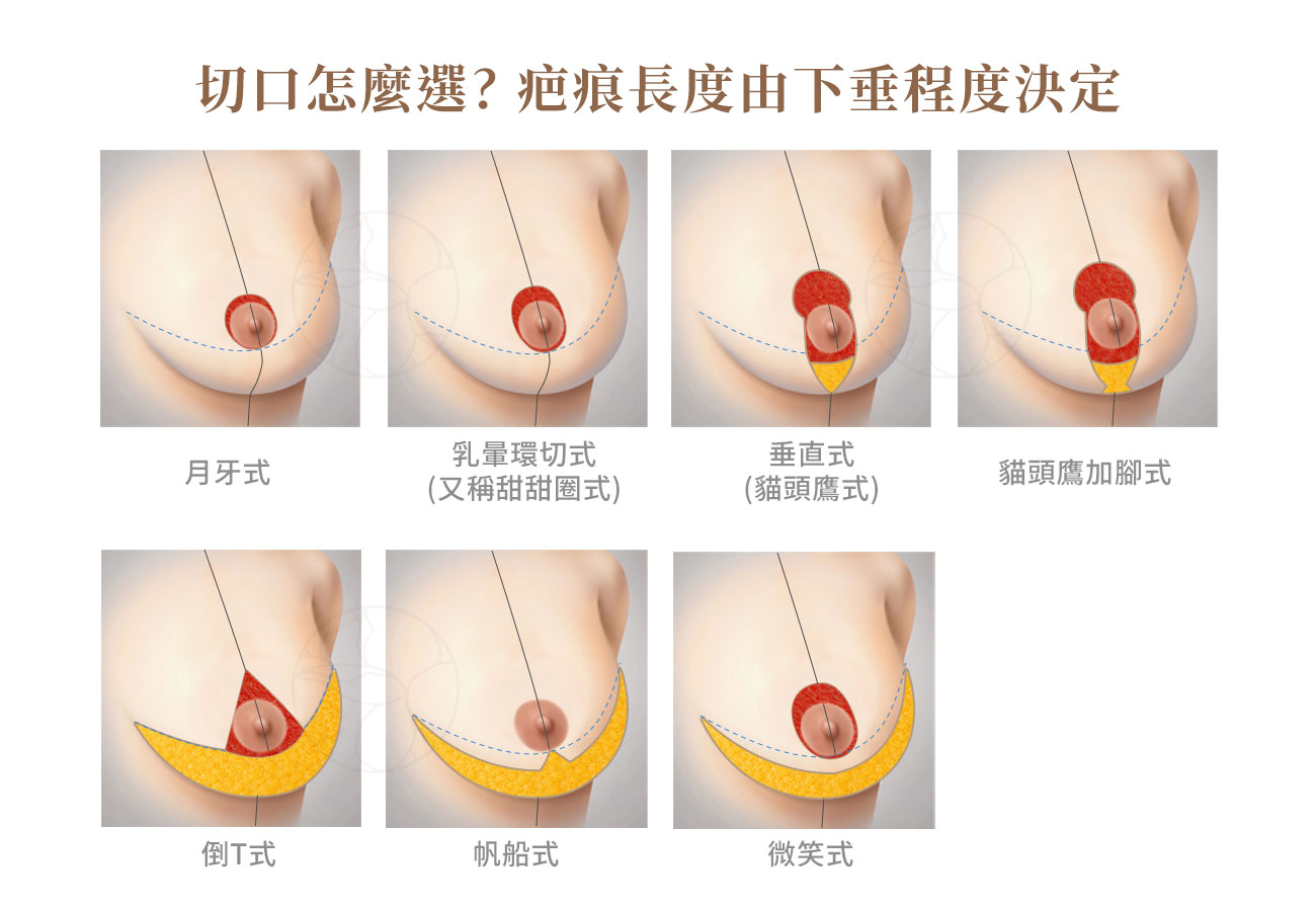提乳切口怎麼選?疤痕長度由下垂程度決定 「微笑」式(smile)「帆船」式(sailboat)月牙式(crescent)或乳暈環切式(甜甜圈式,circumareolar)垂直式/「貓頭鷹」式(owl,又稱棒棒糖式)「貓頭鷹加腳」式(owl with feet)倒 T 式 / Wise pattern(錨形)