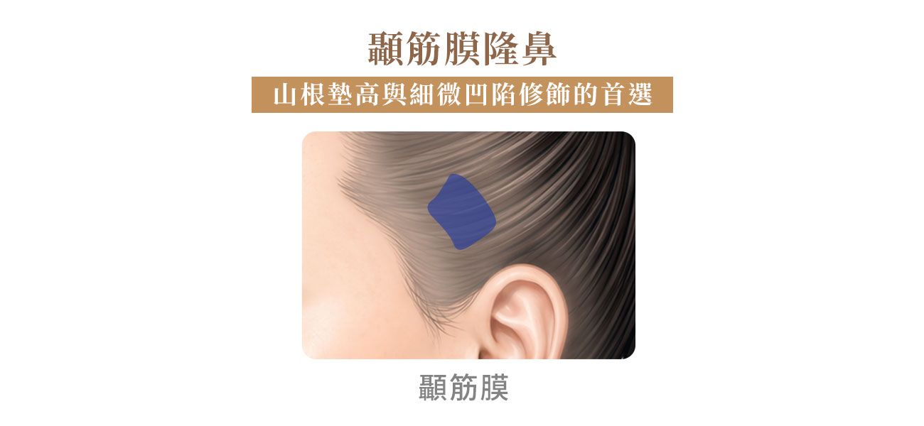 顳筋膜鼻背墊高 顳筋膜鼻背墊高:山根填補與局部修飾