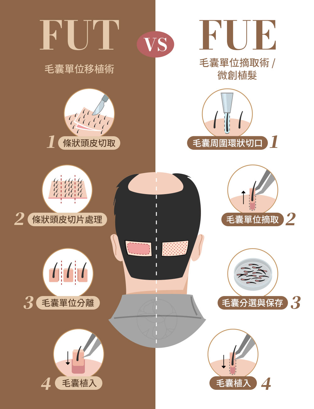 FUT vs FUE 差異全面比較