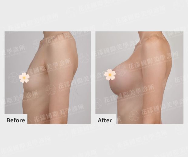 曼陀波絨毛面果凍隆乳案例