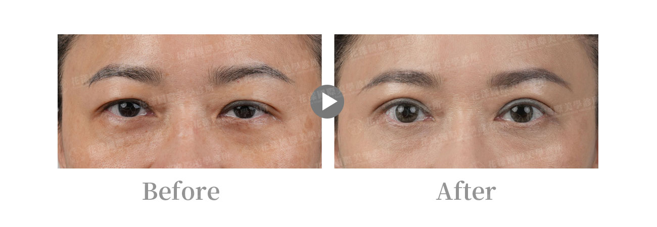 image4 提眼瞼肌手術案例