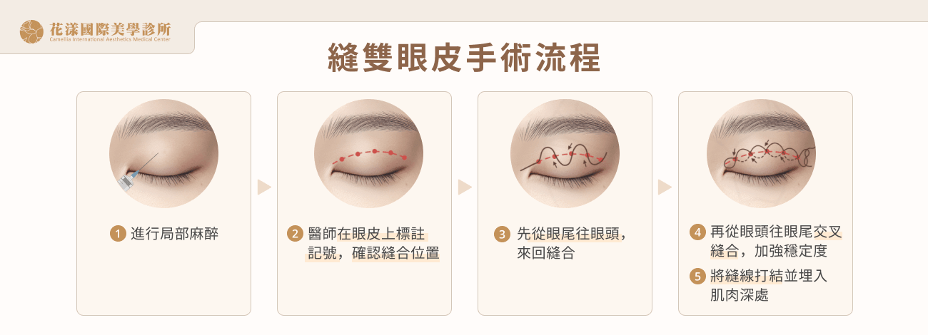 縫雙眼皮手術流程