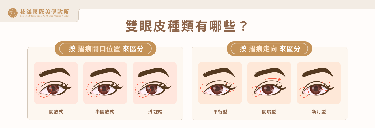 雙眼皮種類有哪些？