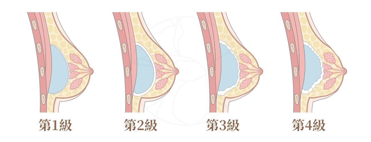 莢膜攣縮4等級圖解 第1級, 外觀自然屬自然現象, 第2級, 摸起來有點硬,但外觀正常. 第3級, 外觀有點不自然,觸感明顯變硬,可能伴隨疼痛, 第4級明顯變形且疼痛明顯,可觸摸到明顯硬塊。