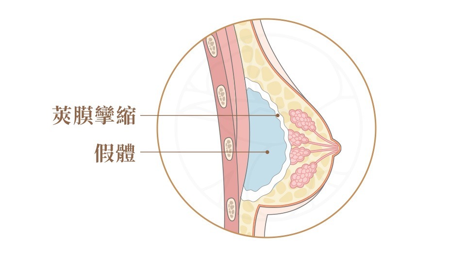 莢膜攣縮 當身體對植入的義乳產生保護機制,形成的莢膜若過度增厚或收縮,可能導致乳房變硬、變形,甚至產生疼痛感。