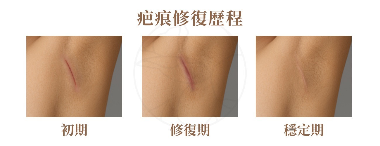 疤痕修復歷程 初期, 修復期, 穩定期