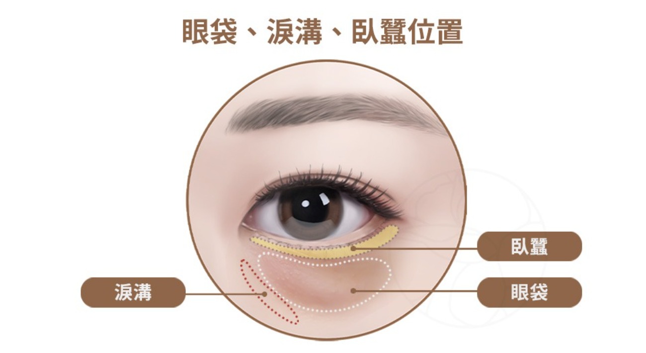 臥蠶、淚溝、眼袋怎麼分? 眼袋是明顯凸出、柔軟腫脹感;臥蠶是微微隆起、近睫毛、有笑感;淚溝是凹陷、陰影感、像一道線