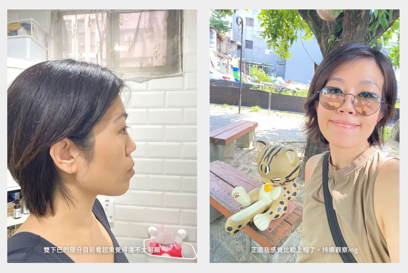 中年婦女第一次打音波｜極限音波＋海芙音波療程體驗分享