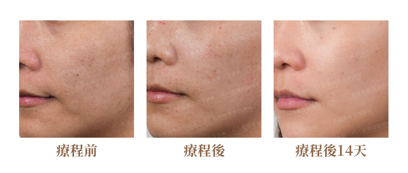 玻尿酸水光針補水案例 玻尿酸水光針補水案例:改善乾燥脫妝與底妝服貼度