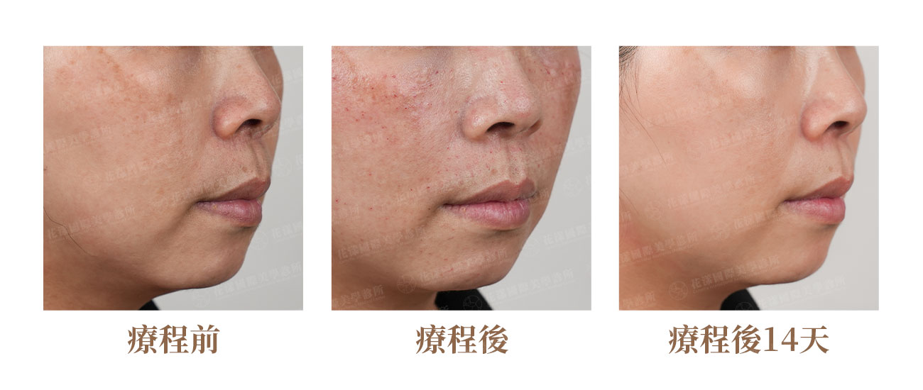 水光針案例：改善細紋卡粉、提升臉部保濕度的成果