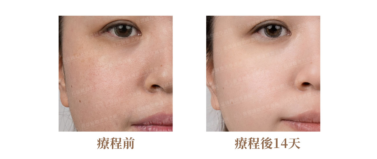 水飛梭案例：改善粉刺與毛孔堵塞的深層清潔成果
