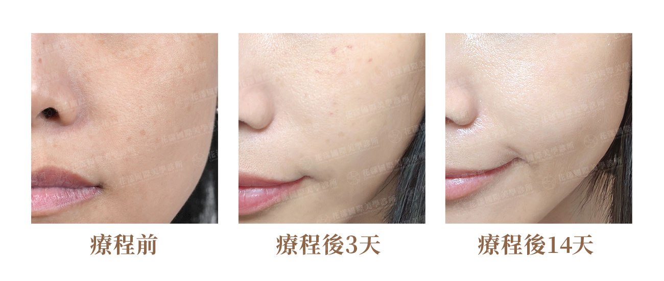 水光針亮膚案例：改善乾燥暗沉、提升肌膚透亮度