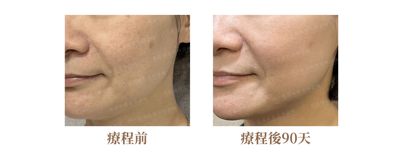 改善前膚色黯沉且斑點明顯。改善後，膚色逐步提亮。