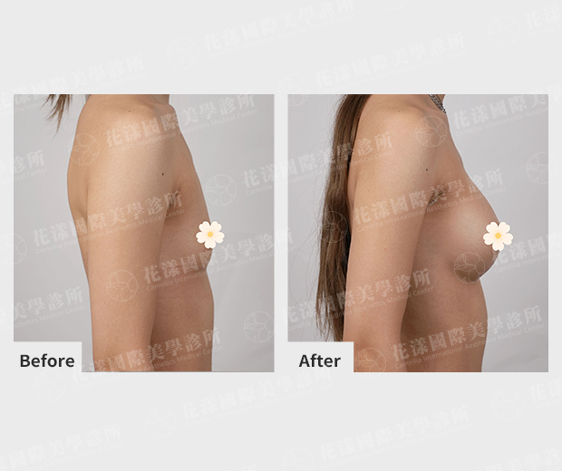 隆乳案例術前、術後比較 隆乳案例術前、術後比較(側面)