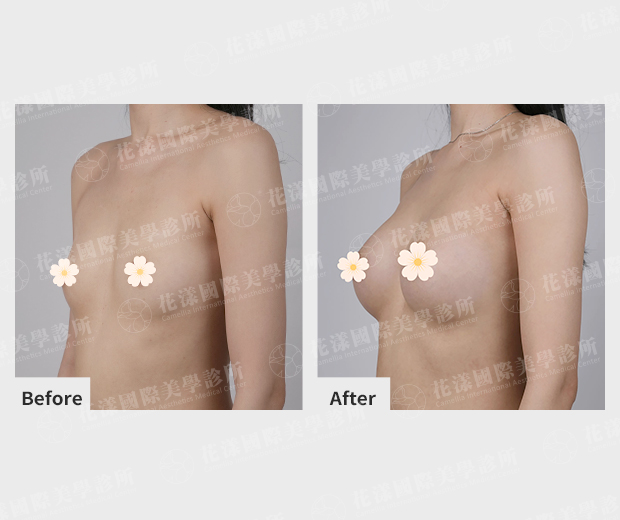 隆乳案例術前、術後比較(45度)