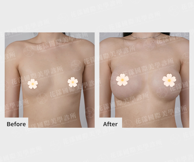 隆乳案例見證 隆乳案例見證