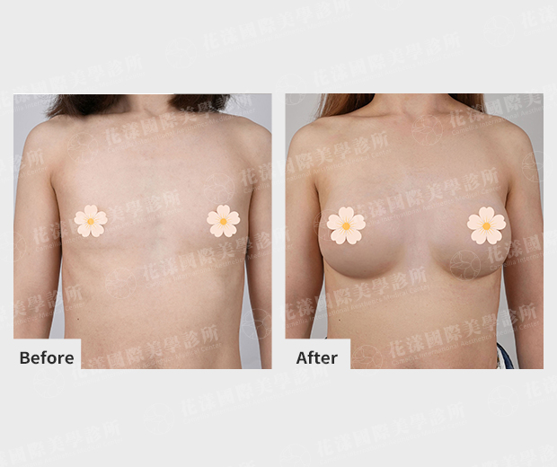 隆乳案例術前、術後比較(正面)