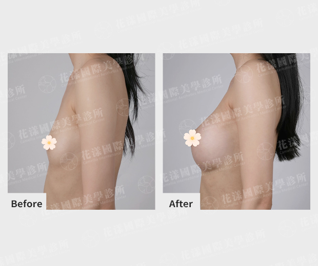 隆乳案例術前、術後比較(側面)