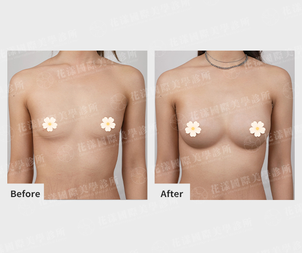 隆乳案例 隆乳案例術前、術後比較(正面)